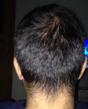 hair-restoration-in-turkey (4)