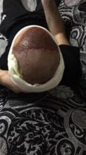 hair-restoration-in-turkey (5)
