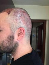 hair-restoration-in-turkey (6)