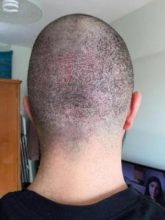hair-restoration-in-turkey (7)