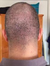 hair-restoration-in-turkey (8)