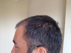 hair-restoration-in-turkey (9)