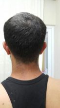 hair-transplant (1)