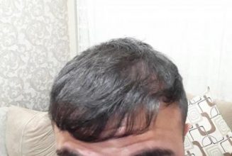 hair-transplant (10)