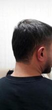 hair-transplant (11)