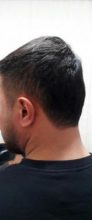hair-transplant (12)