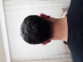 hair-transplant (13)