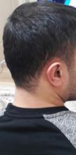 hair-transplant (15)