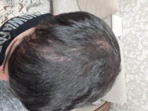 hair-transplant (17)