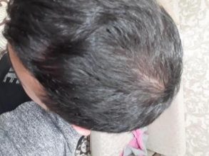 hair-transplant (18)