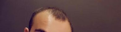 hair-transplant (19)