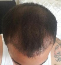 hair-transplant (2)