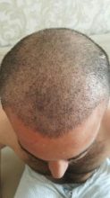 hair-transplant (20)