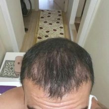 hair-transplant (21)