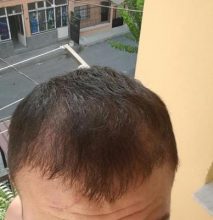 hair-transplant (22)