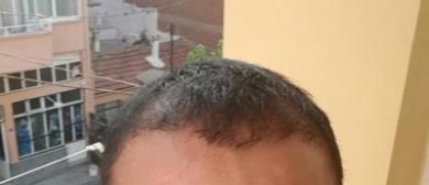 hair-transplant (23)