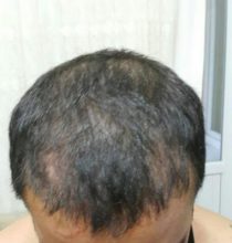 hair-transplant (24)
