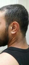hair-transplant (25)