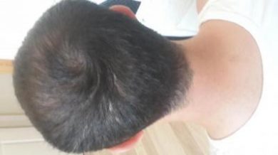 hair-transplant (4)