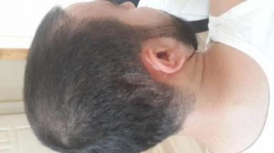hair-transplant (5)