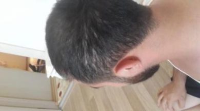 hair-transplant (6)