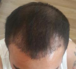 hair-transplant (7)