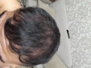 hair-transplant (8)