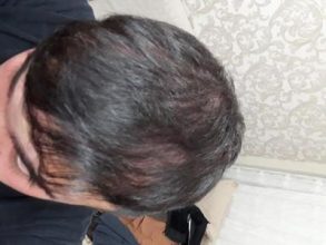 hair-transplant (9)