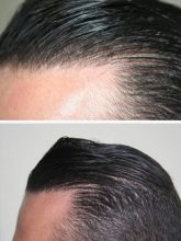 hair-transplant-best-results (1)