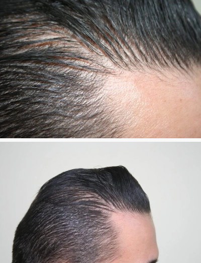 hair-transplant-best-results (2)