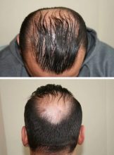 hair-transplant-best-results (3)