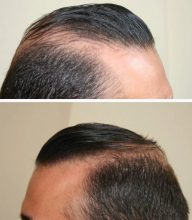 hair-transplant-best-results (4)
