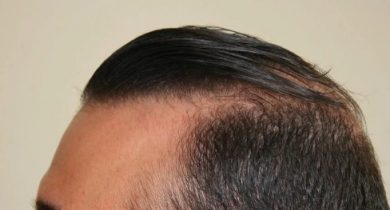 hair-transplant-best-results (5)