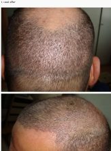 hair-transplant-best-results (6)