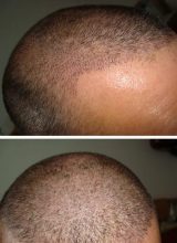 hair-transplant-best-results (7)