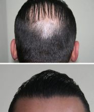 hair-transplant-best-results (8)
