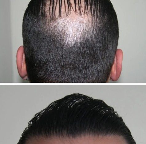 hair-transplant-best-results (8)