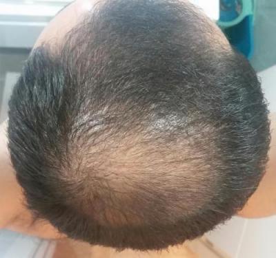 hair-transplant-istanbul (10)