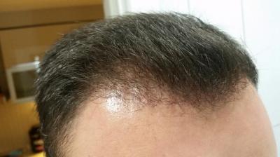 hair-transplant-istanbul (12)