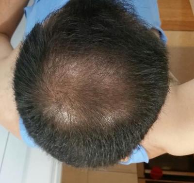hair-transplant-istanbul (13)