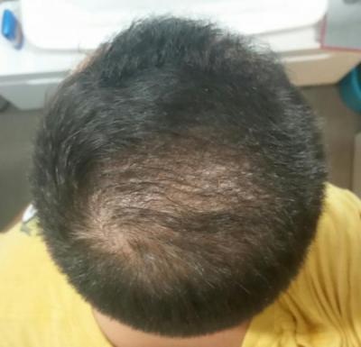 hair-transplant-istanbul (18)
