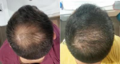 hair-transplant-istanbul (19)