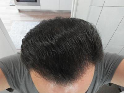 hair-transplant-istanbul (22)