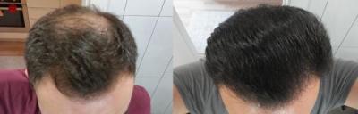 hair-transplant-istanbul (24)