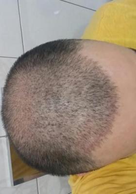 hair-transplant-istanbul (7)