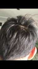 hair-transplant-turkey-best (2)