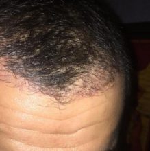 hair-transplant-turkey-best (3)