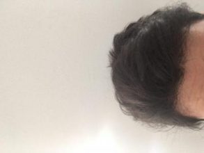 hair-transplant-turkey-best (4)