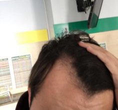 hair-transplant-turkey-best