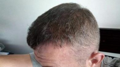 hair-transplant-turkey-blog (1)